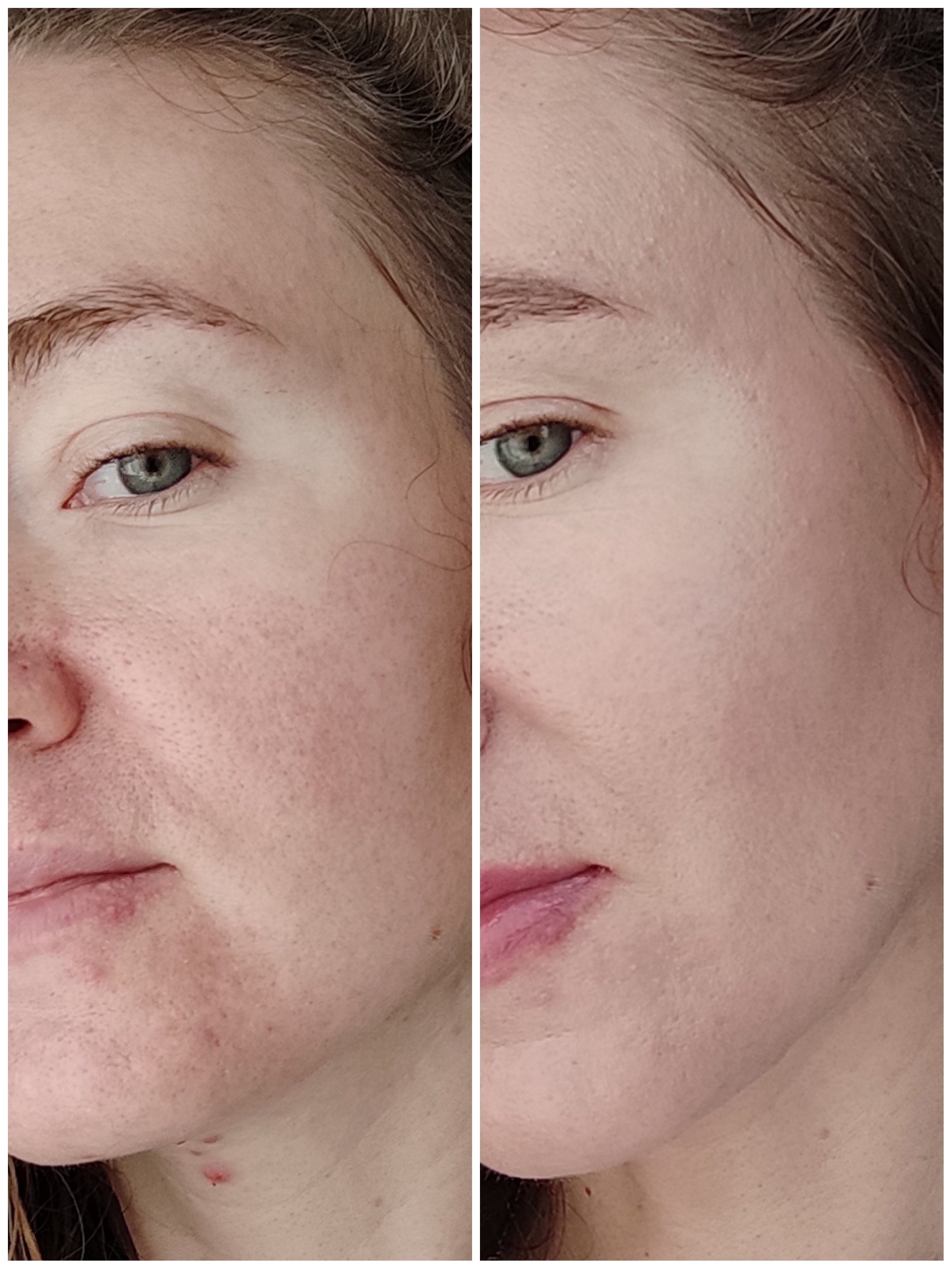 Purito Cica Clearing BB cream проти шкіри з розацеа: хто кого?)