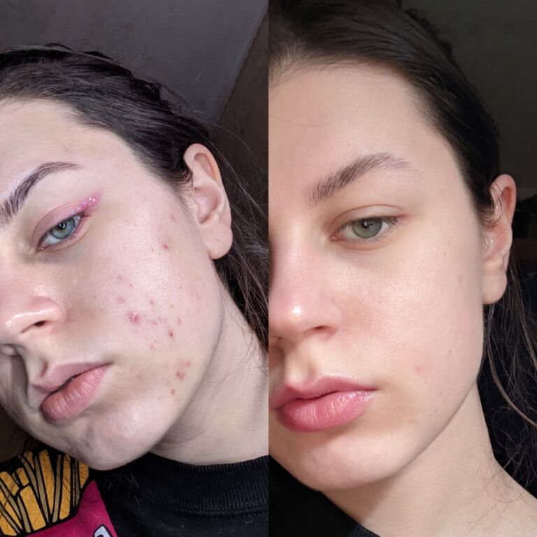 Як бюджетно врятувати свою шкіру (фото до і після)