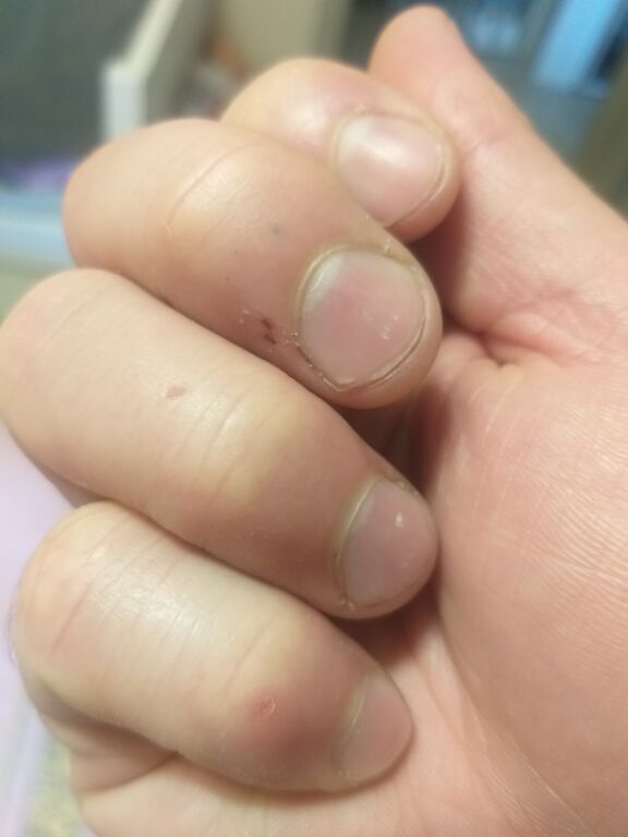шкіра рук після хімічних засобів