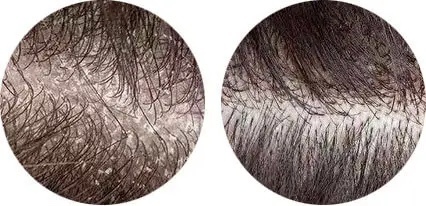 Пілінги та скраби для шкіри волосяної частини шкіри голови