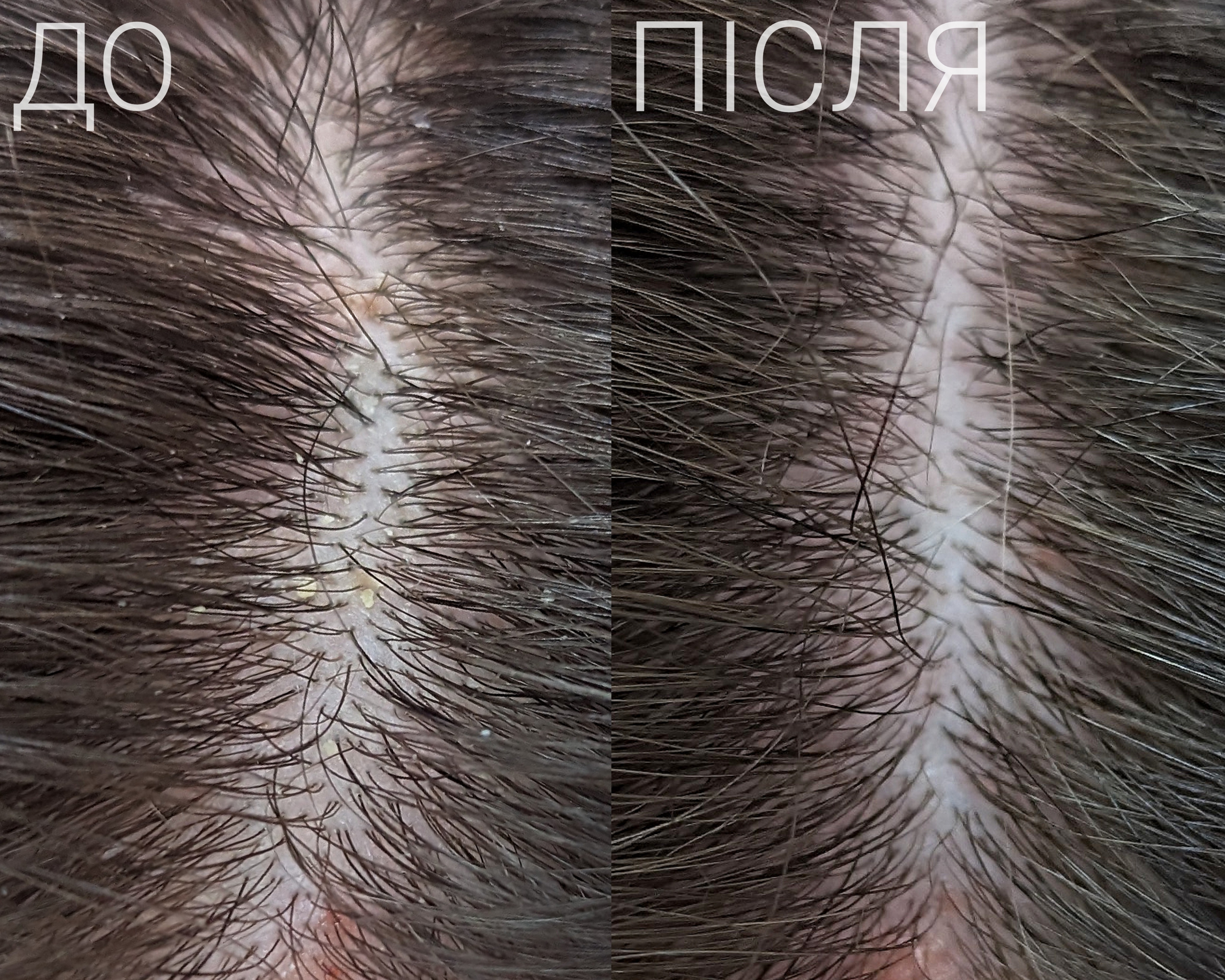 Скраб для голови Pharmaceris: Глибоке очищення шкіри та стимуляція росту волосся