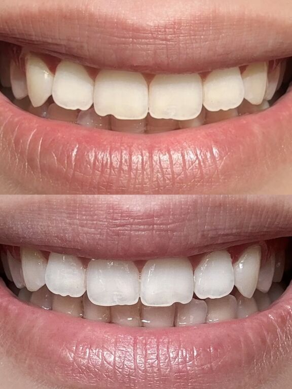 Здорова білизна зубів